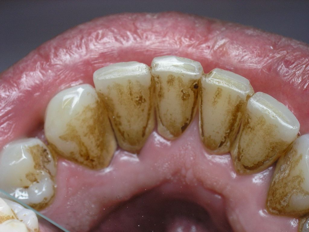 Причины появления зубного налета